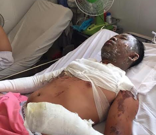 Chồng bỏng nặng vì vợ hắt chảo dầu nóng vào mặt