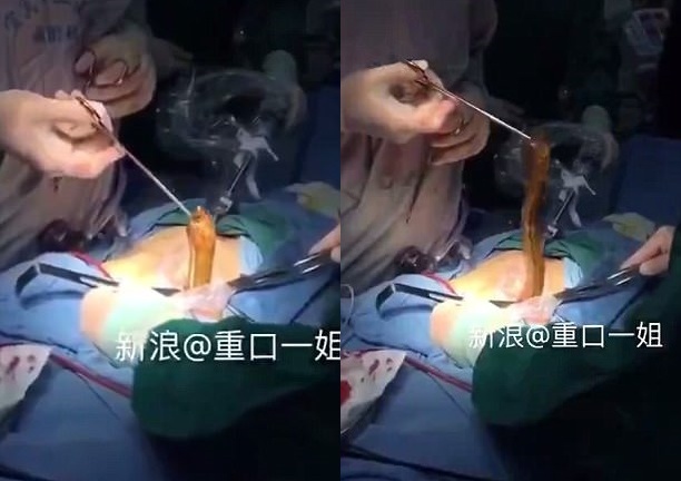 Bác sĩ phẫu thuật, gắp lươn ra khỏi bụng bệnh nhân gặp nạn vì tự sướng