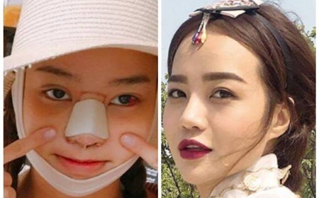 Hoa hậu Kiều Ngân bất ngờ lộ mặt sưng vù vì phẫu thuật thẩm mỹ