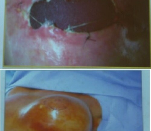 Vụ khách hàng gặp sự cố khi phẫu thuật nâng ngực, chị em phụ nữ chú ý gì?