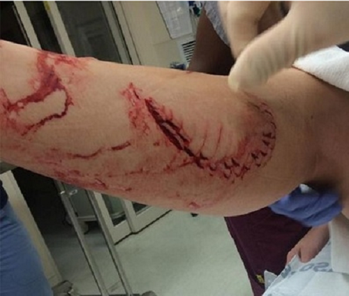 Cô gái bất ngờ bị mất cả mảng thịt ở chân sau khi đi biển về