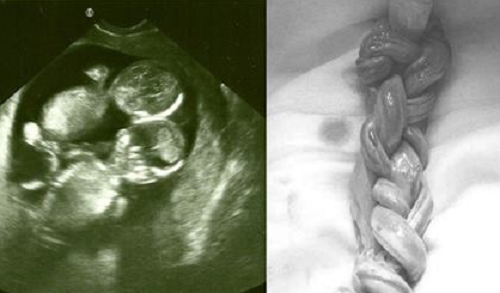 Cặp song sinh sống sót kỳ diệu dù dây rốn quấn chặt vào nhau như tết tóc