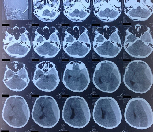 Mới 20 tuổi, chỉ vì cú ngã, tưởng không làm sao ai ngờ tử vong