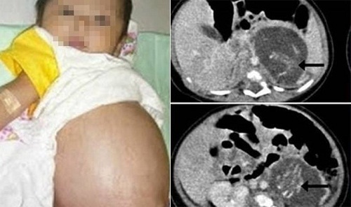 Sự thật phía sau câu chuyện bé gái vừa sinh ra đã trở thành “mẹ”