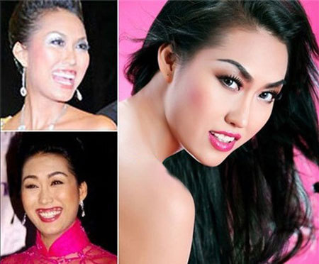 Cuộc đại phẫu thuật trùng tu nhan sắc của Phi Thanh Vân với chi phí nửa tỷ đồng