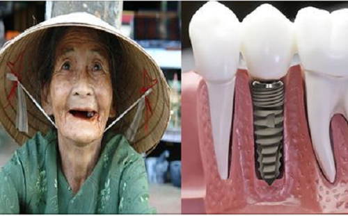 Câu chuyện con trai giàu có làm loại răng giả rẻ tiền cho mẹ và bài học đáng suy ngẫm