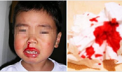 Con trai 2 tuổi qua đời vì chảy máu cam, mẹ hối hận phát điên khi biết nguyên nhân