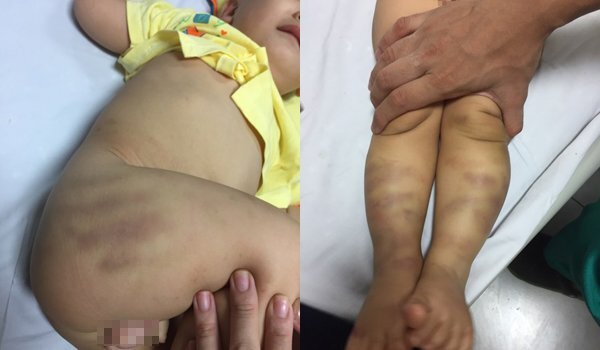Tình hình sức khỏe của bé trai 1 tuổi bị bạo hành, bỏ lại bệnh viện