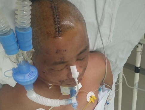 Chồng ngã rách toác đầu, chấn thương sọ não: Vợ cay đắng chỉ có vài đồng chữa chạy