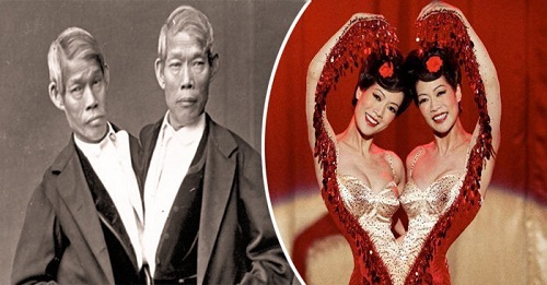 Những cặp ‘dị nhân’ sinh đôi dính liền nổi tiếng khắp thế giới