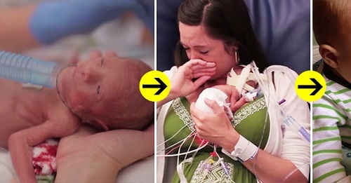 Sự thay đổi khó tin sau 1 năm của bé sinh non, nhỏ bằng quả dưa chuột