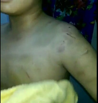 Bé trai 9 tuổi bị mẹ ruột và dì họ bạo hành nhập viện cấp cứu