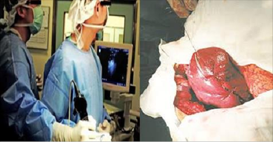 Có một loại thực phẩm gây ung thư gan mà bạn không ngờ tới