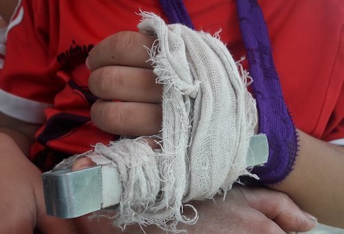 Cô giáo mầm non bị tố đánh gãy ngón tay bé trai 5 tuổi
