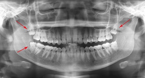 Bà bầu trẻ bị răng khôn đâm... thủng má