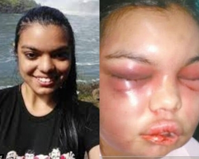Cô gái trẻ bị bạn trai đánh biến dạng mặt chỉ vì được nhiều người 'Like' ảnh trên Facebook