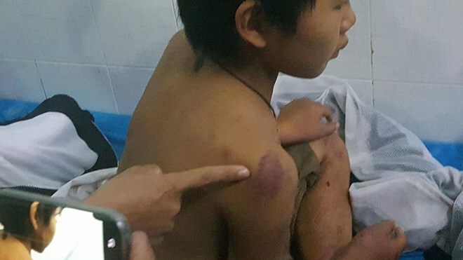 Đi chơi không xin phép, cậu bé 11 tuổi bị bố đánh dã man