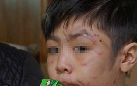 Bi kịch sau ly hôn là những vụ trẻ bị bố đẻ bạo hành 