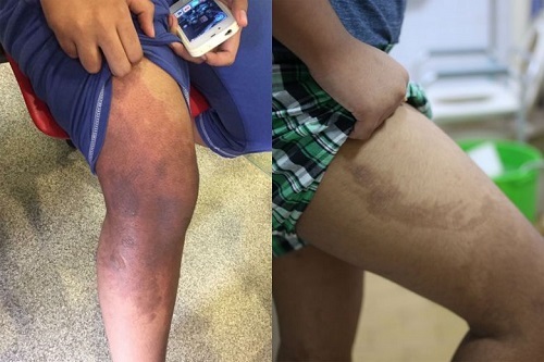 Nữ giúp việc đổ chảo dầu nóng làm bỏng con trai chủ nhà