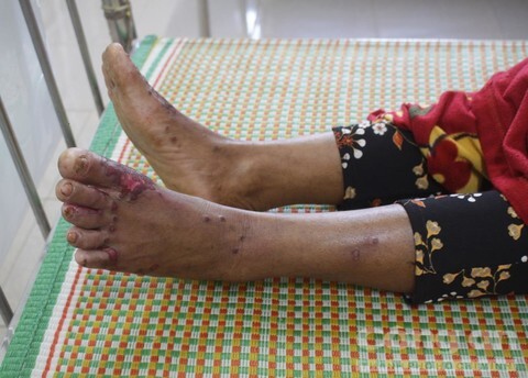 Một học sinh mắc