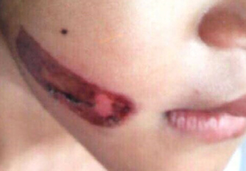 Bé gái nghi bị cha, mẹ kế bạo hành bằng sắt nung đỏ