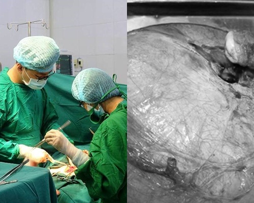 Tự uống lá thuốc điều trị suốt 4 năm vì sợ mổ, đến khi khối u xơ nặng tới 4kg