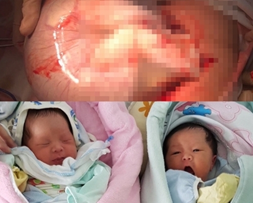 Hiếm gặp: Sản phụ sinh đôi, 1 bé gái còn nguyên trong bọc ối