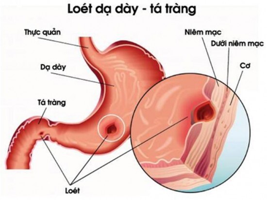 Bác sĩ cảnh báo sai lầm trong trị bệnh dạ dày bằng tinh nghệ