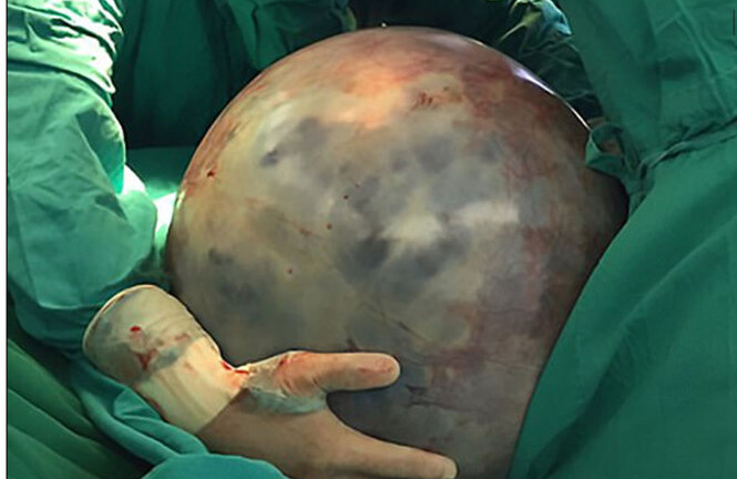 Người phụ nữ mang khối u 