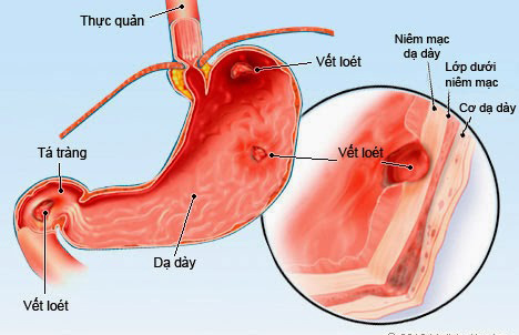 Những điều cần biết về bệnh viêm dạ dày cấp