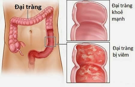 Chữa bệnh đại tràng bằng Đông y hiệu quả