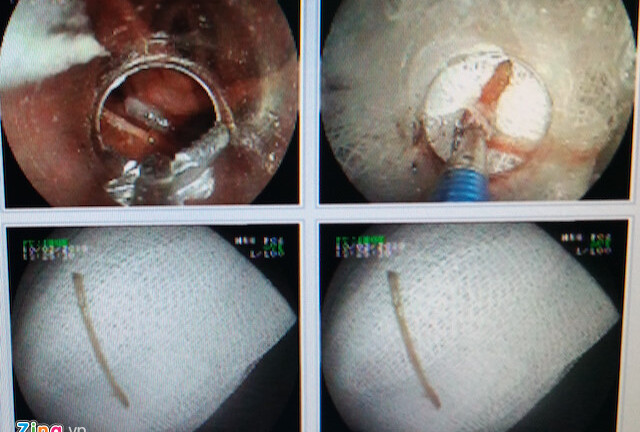 Suýt mất mạng vì hóc...xương vịt