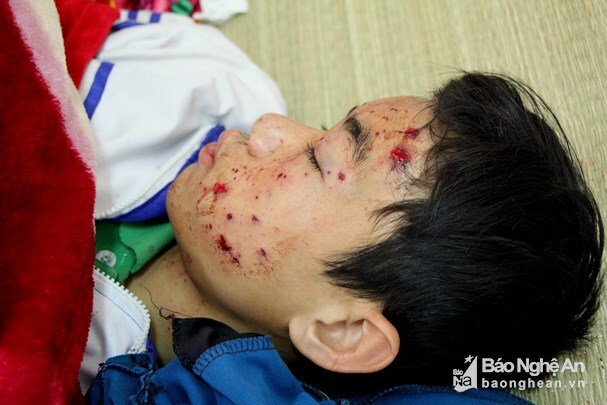 Điện thoại nổ khi đang sạc, nam sinh lớp 8 ở Nghệ An nhập viện