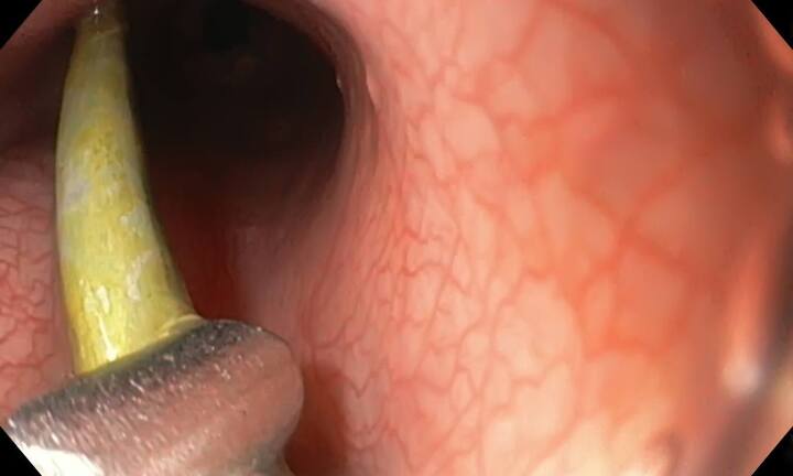 Gắp đinh 3cm ra khỏi đường tiêu hóa bé trai 2 tuổi