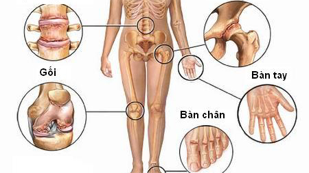 Những điều cần biết về viêm đa khớp dạng thấp