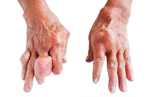 Nguyên nhân và triệu chứng thường gặp của bệnh gout
