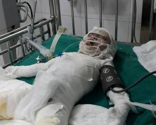 Cháu bé ngã vào hố vôi đang sôi sùng sục đã không qua khỏi
