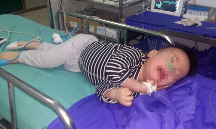 Bé trai 15 tháng tuổi bị xương cắm ngang thực quản sau khi ăn cháo cá
