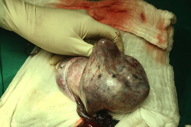 Bé gái 13 tuổi bị u nang buồng trứng như mang thai 6 tháng