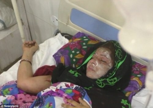 Chồng tạt axit vào mặt vợ vì