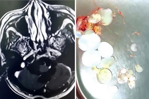 Lúc nhúc 30 trứng sán dây trong não
