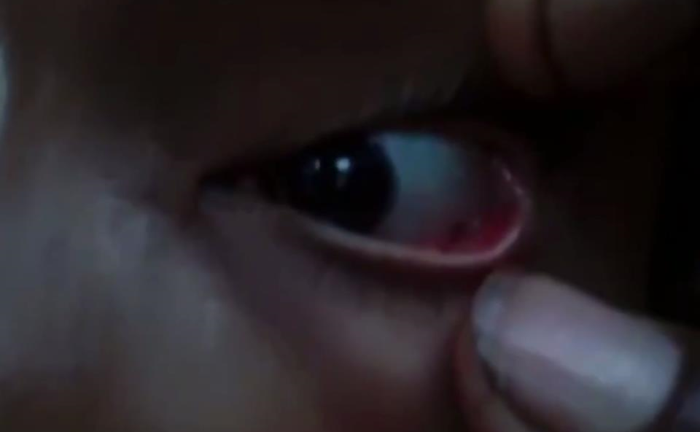 Kinh hoàng phát hiện 60 con kiến làm tổ trong mắt bé gái 11 tuổi