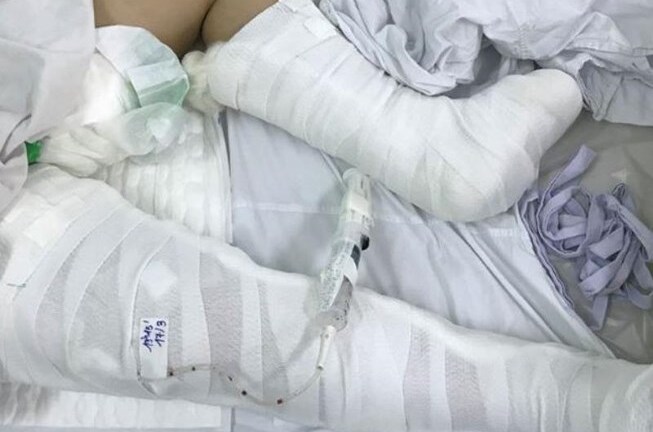 Bé gái 13 tuổi rơi từ lầu 3 may mắn thoát chết