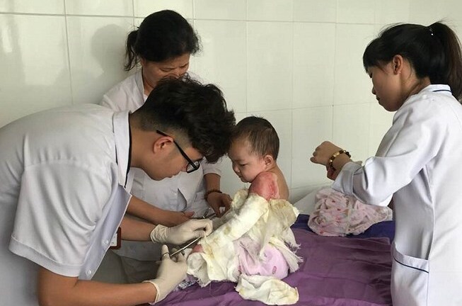 Mẹ bất cẩn, con trai 4 tuổi ngã vào chậu nước sôi