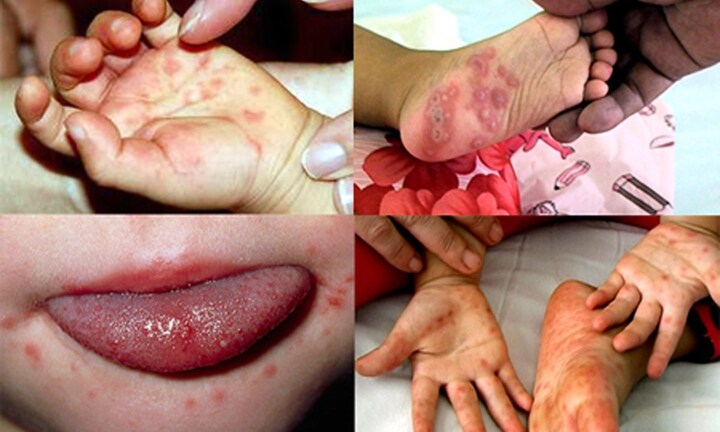 Nhiều trẻ mắc bệnh tay chân miệng, cha mẹ cần theo dõi những dấu hiệu sớm để kịp xử trí