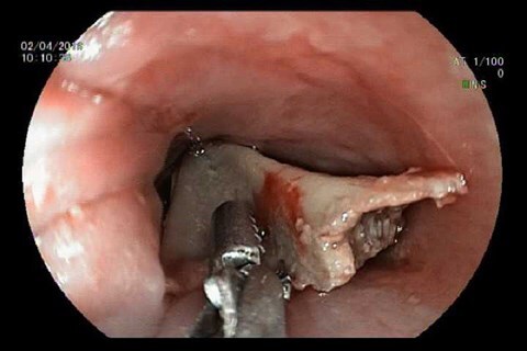 Người đàn ông hóc xương vịt được bác sĩ chẩn đoán... bệnh tim