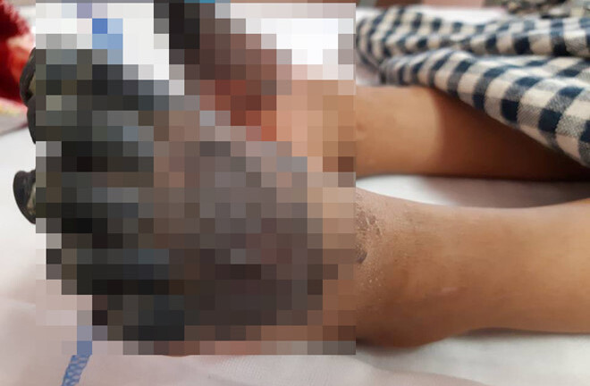 Chỉ sau 1 đêm sốt cao, bé gái 3 tuổi phải cắt bỏ tứ chi