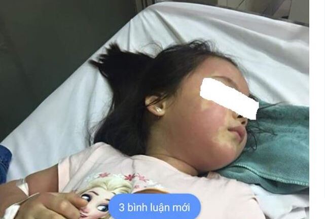 Thực hư vụ bé gái 5 tuổi nổi mẩn khắp người nhập viện cấp cứu nghi do ngộ độc trà sữa