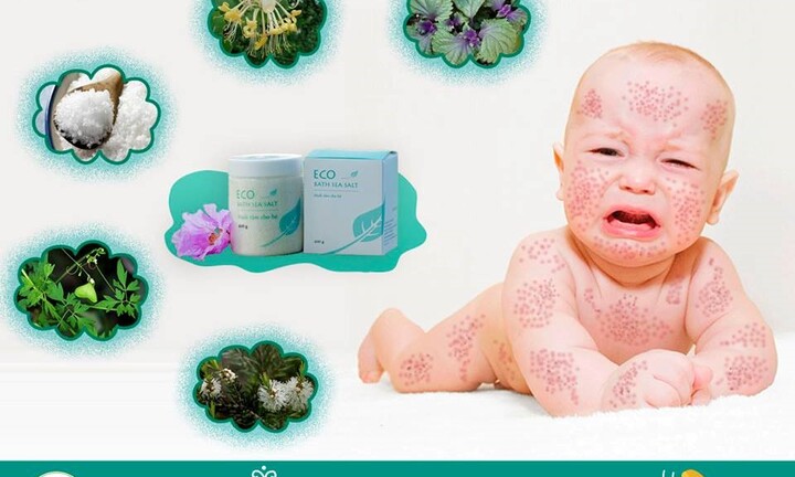 Rôm sảy, mẩn ngứa mùa hè ở trẻ