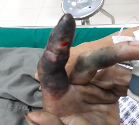 Hoại tử ngón tay do đắp thuốc nam sau khi bị rắn cắn